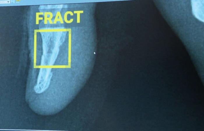 VIDEO – Fratture rilevate in un clic: l’intelligenza artificiale sta rivoluzionando la radiologia