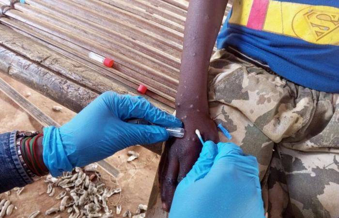 L'OMS preoccupata per la situazione del Mpox in Africa | APAnews