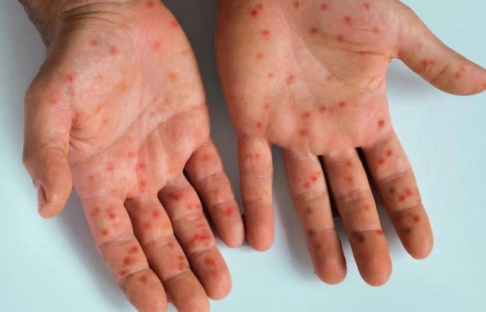 Il morbillo si diffonde in Marocco, la vaccinazione in prima linea per evitare l’epidemia