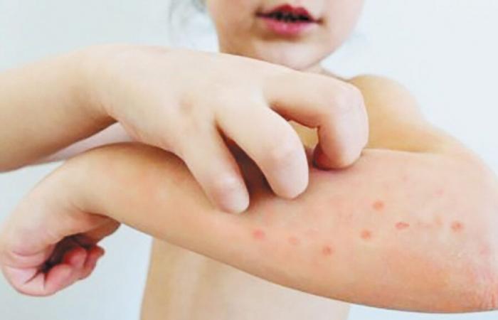 L’epidemia di morbillo termina nell’area di Fredericton