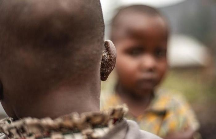 (Multimedia) Mpox: circa 14.700 casi confermati in un anno in Africa (Oms) – Xinhua