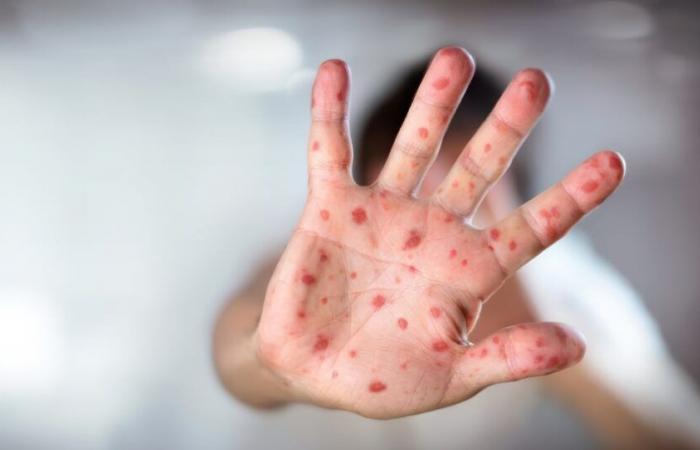 Come il Marocco intende affrontare l’epidemia di morbillo