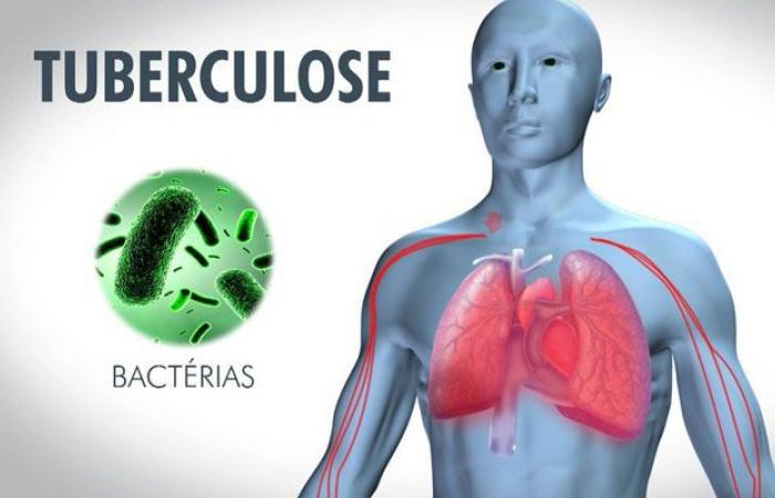 La tunisia riduce significativamente i casi di tubercolosi