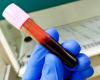 un nuovo esame del sangue per misurare la risposta immunitaria al virus Epstein Barr