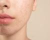 Quali sono i migliori rimedi naturali contro l’acne?