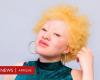 Albinismo: i miti su questa condizione hanno portato gli uomini ad abusare di me