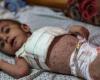 A Gaza scabbia e pidocchi si diffondono tra i bambini