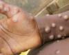 MPOX colpisce duramente i bambini in Burundi