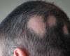 nuove molecole per trattare l’alopecia areata