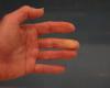 Hai le mani fredde? Questo test di 1 minuto ti dirà se hai la sindrome di Raynaud