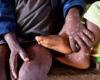 20 paesi africani colpiti dal virus Mpox (Africa CDC) | APAnews